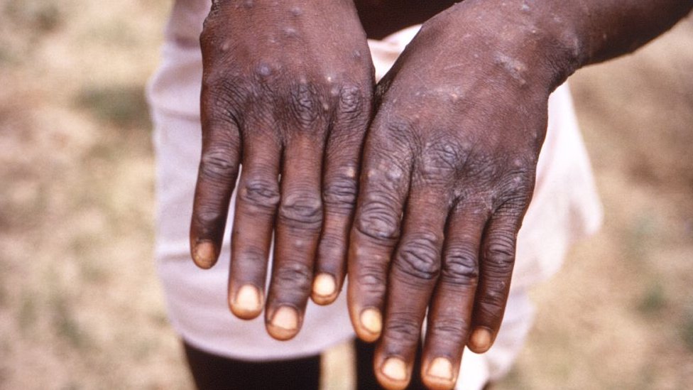 Explainer: Why monkeypox cases dey spread for Europe, US