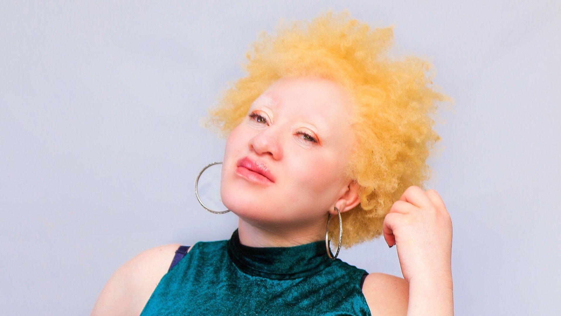 Regina Mary Ndlodvu na woman wit albinism