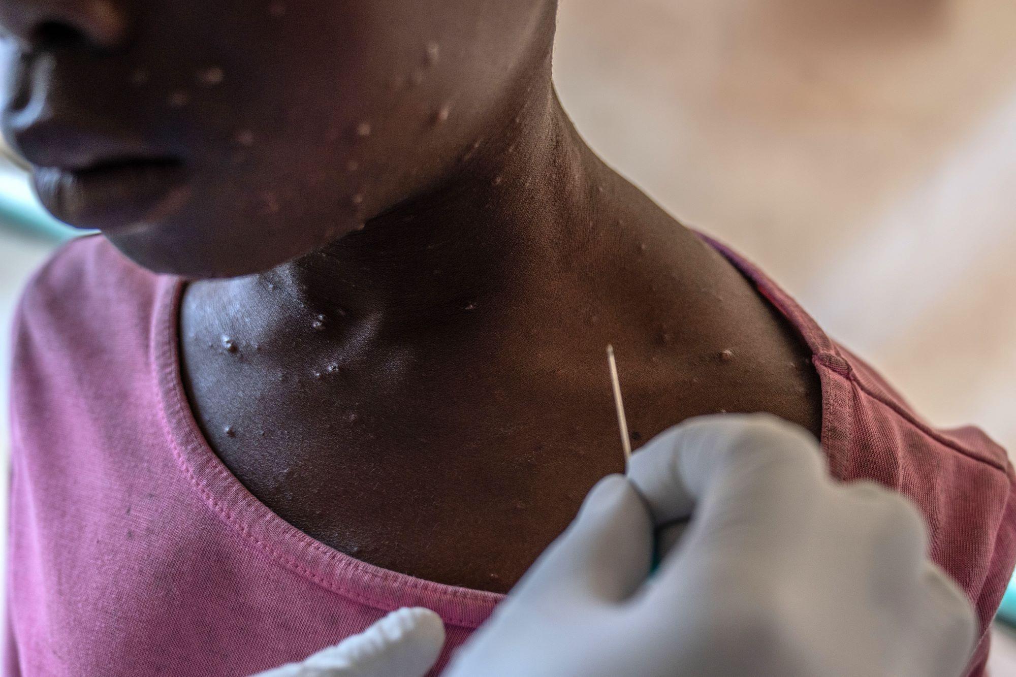 A boy receives treatment for mpox at Munigi Health Centre in Munigi, DR Congo, on 19 August 2024