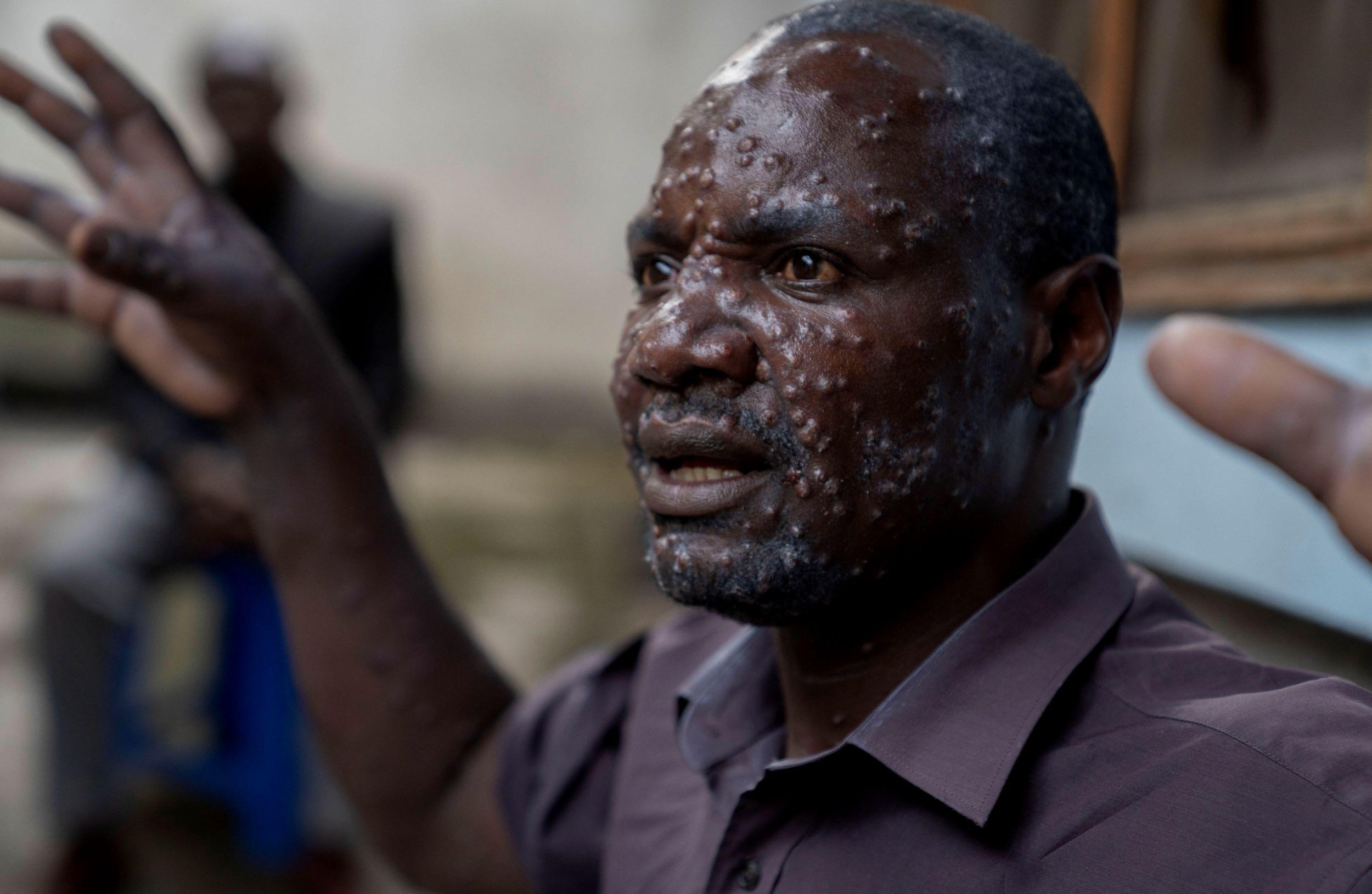 A 48-year-old from the Muja internally displaced persons camp in DR Congo received treatment for Mpox in Goma hospital in July